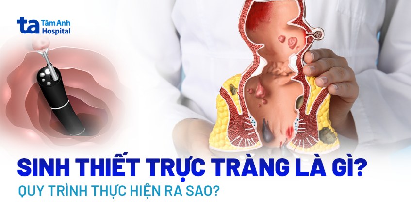 Sinh thiết trực tràng: Khi nào cần thực hiện, quy trình ra sao?