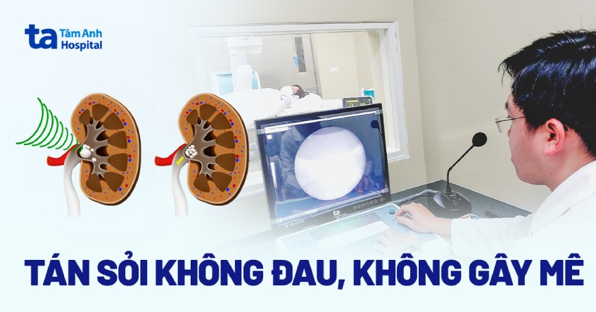 Điều trị sỏi thận không mổ, không uống thuốc