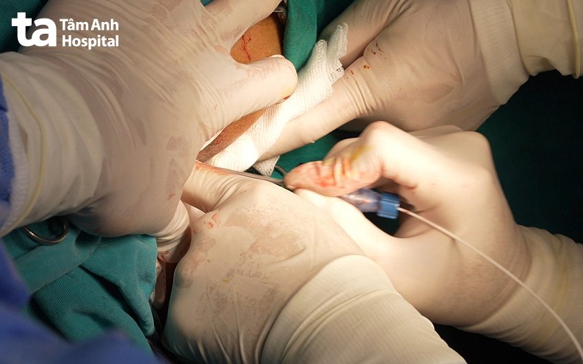 tia laser chữa trĩ