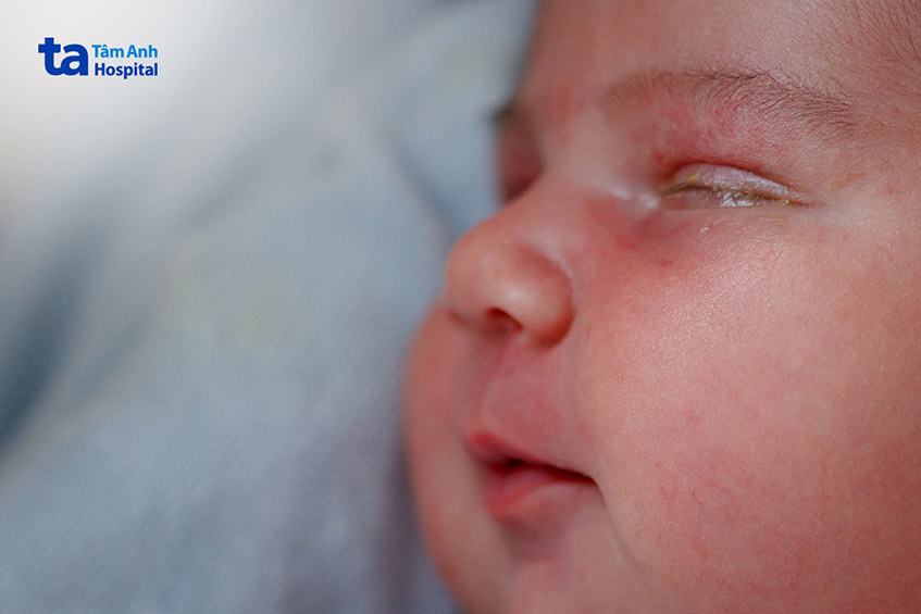 tình trạng đổ ghèn vàng