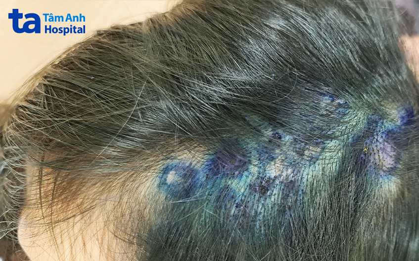 Tình trạng nhọt trước khi điều trị. 