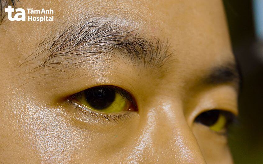 triệu chứng áp xe gan nhiễm khuẩn