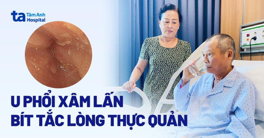 U phổi xâm lấn bít tắc lòng thực quản