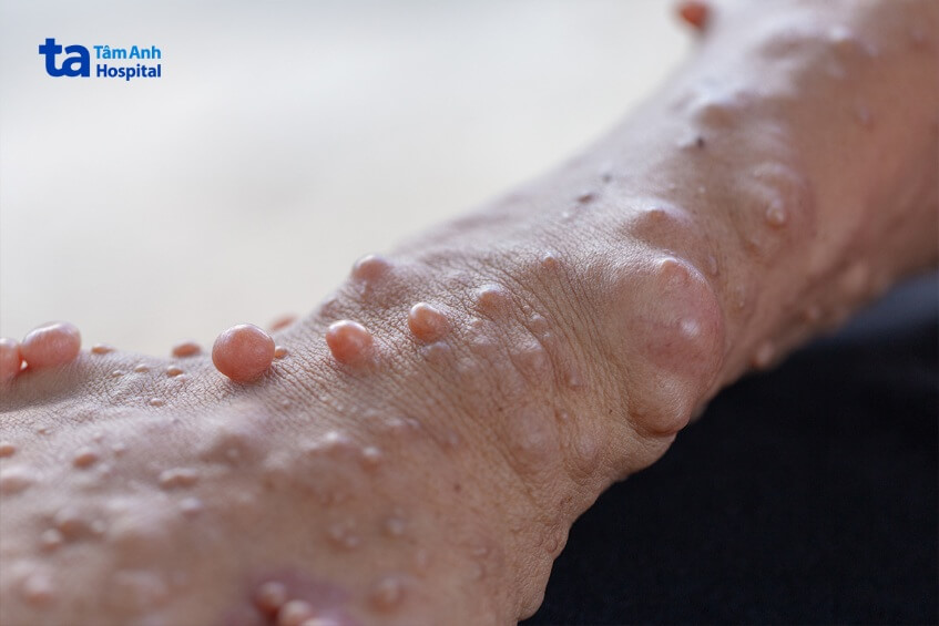 u xơ dây thần kinh