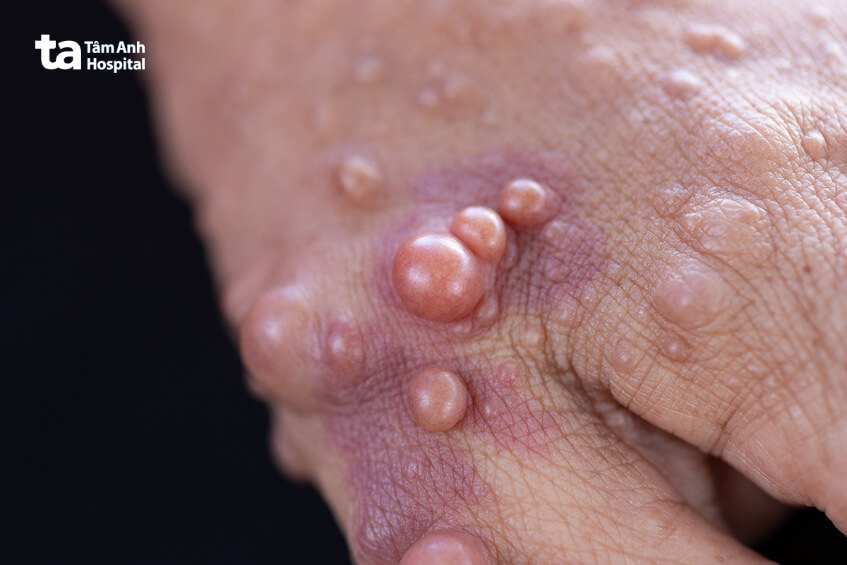 u xơ thần kinh có chữa được không