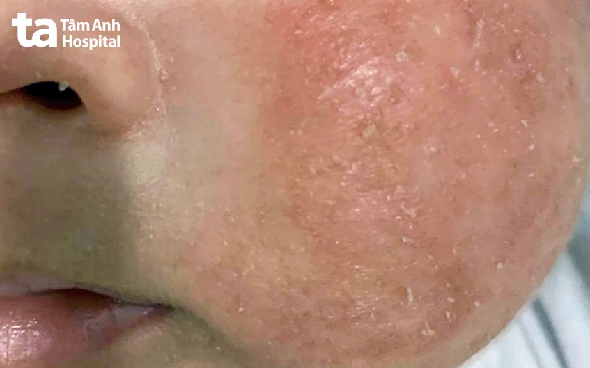 Tình trạng viêm da cơ địa của trẻ trước khi điều trị.