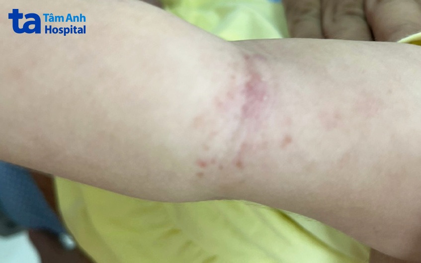 Cẳng tay, chân là các vùng da dễ bị viêm da cơ địa.