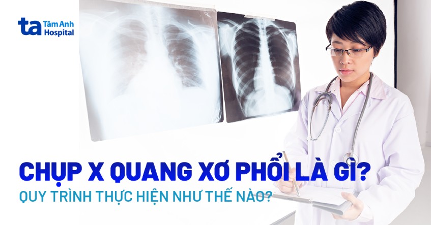 Chụp X-quang xơ phổi: Khi nào cần thực hiện và các lưu ý