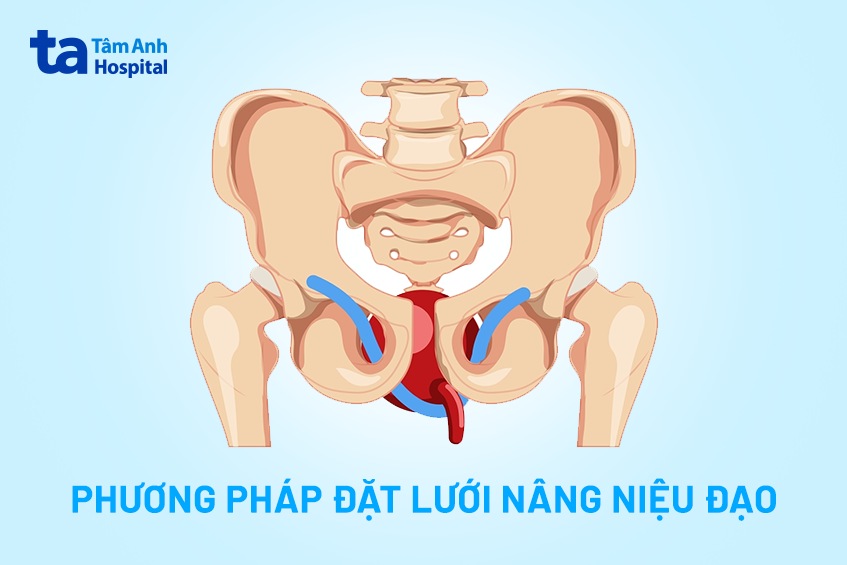 ảnh minh hoạ đặt lưới nâng niệu đạo