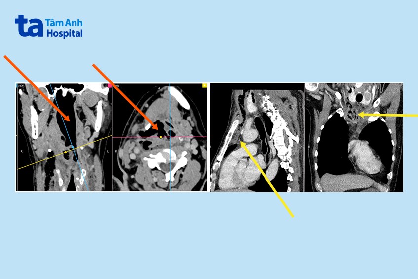 Áp xe vùng cổ lan xuống trung thất 