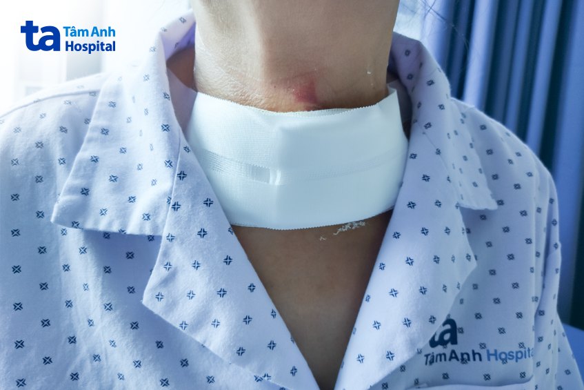 Bà Q. sau khi phẫu thuật ung thư tuyến giáp