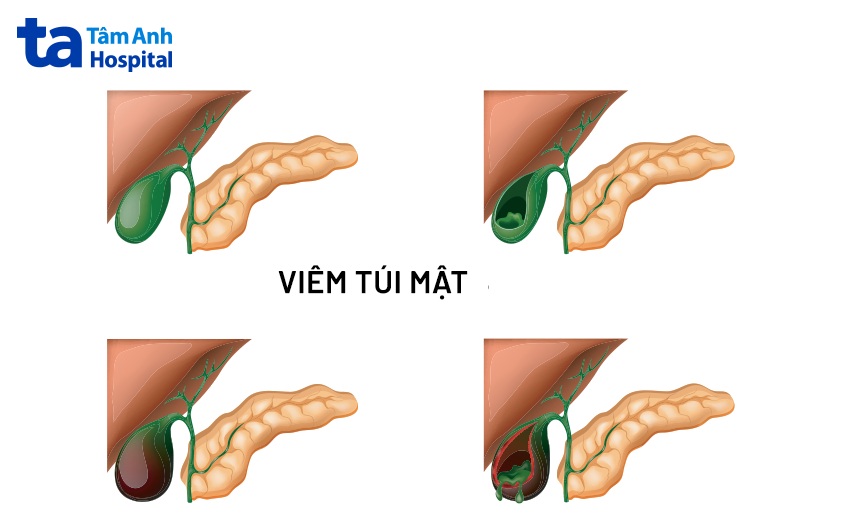 bị viêm túi mật