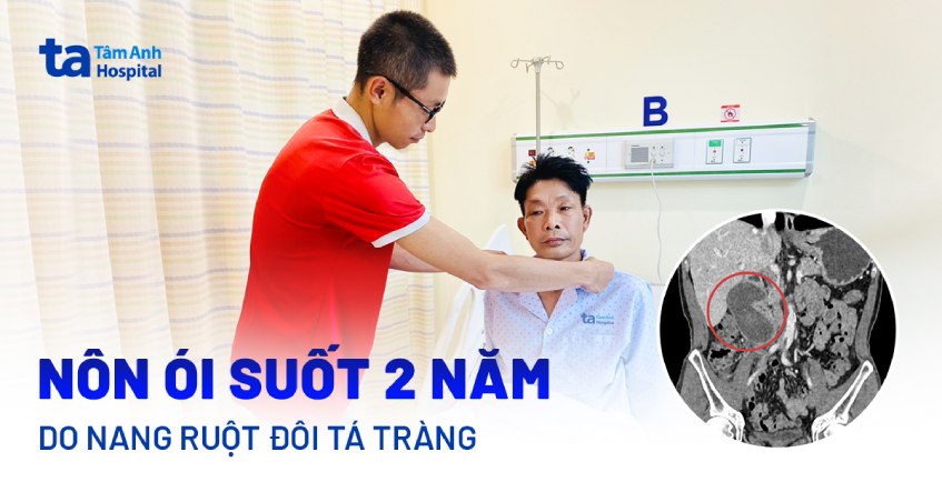 Nang ruột đôi khiến người đàn ông nôn ói suốt hai năm