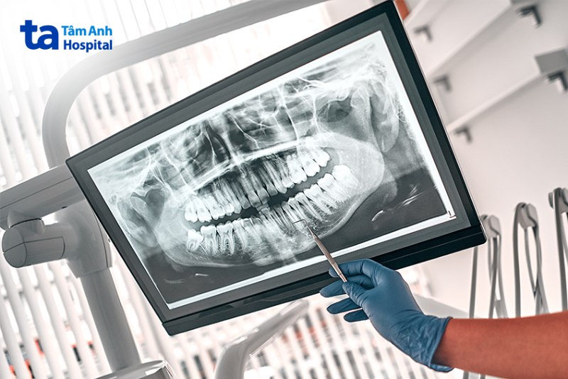 Chẩn đoán bệnh tuỷ răng