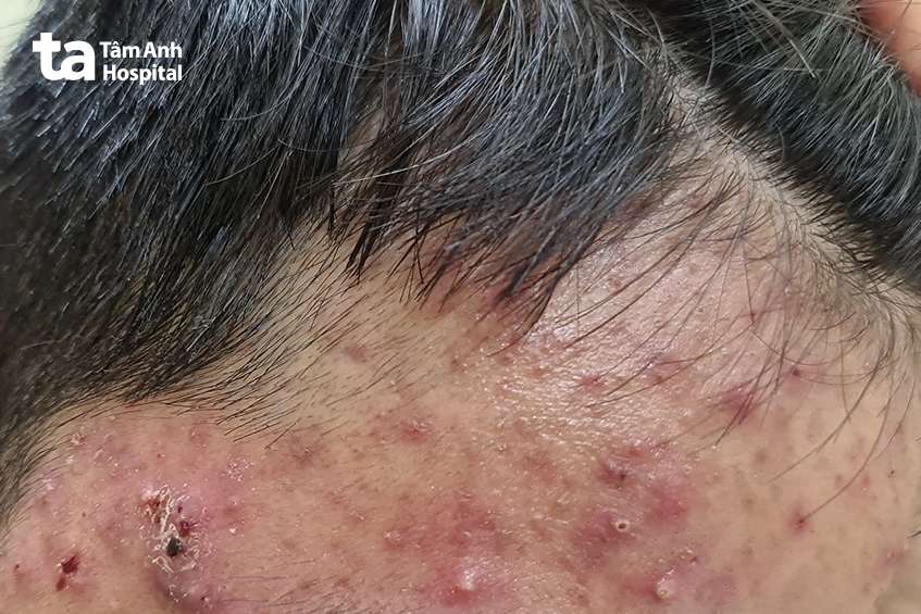 da bùng phát khi tự ý điều trị tại nhà bằng corticoid