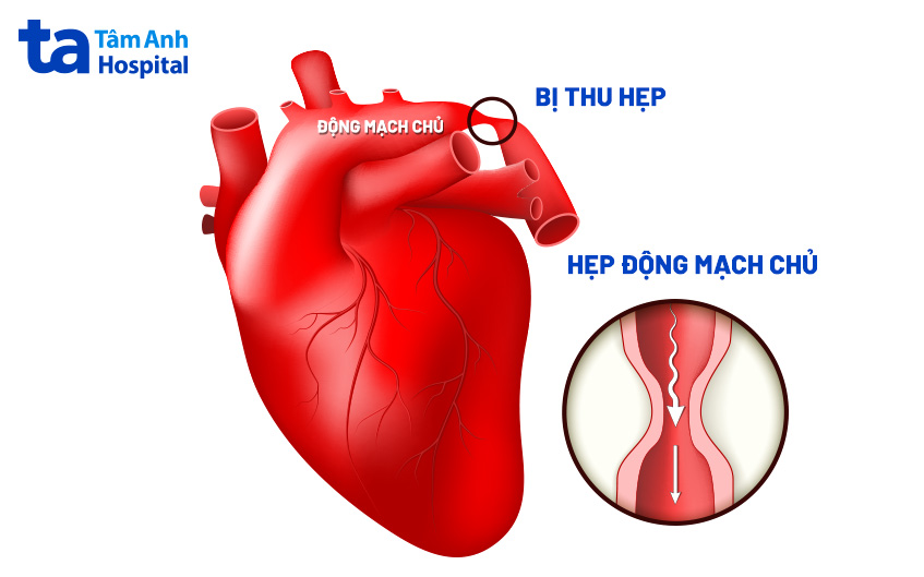Động mạch chủ bị hẹp eo khiến cho lưu lượng máu từ tim đến các bộ phận giảm