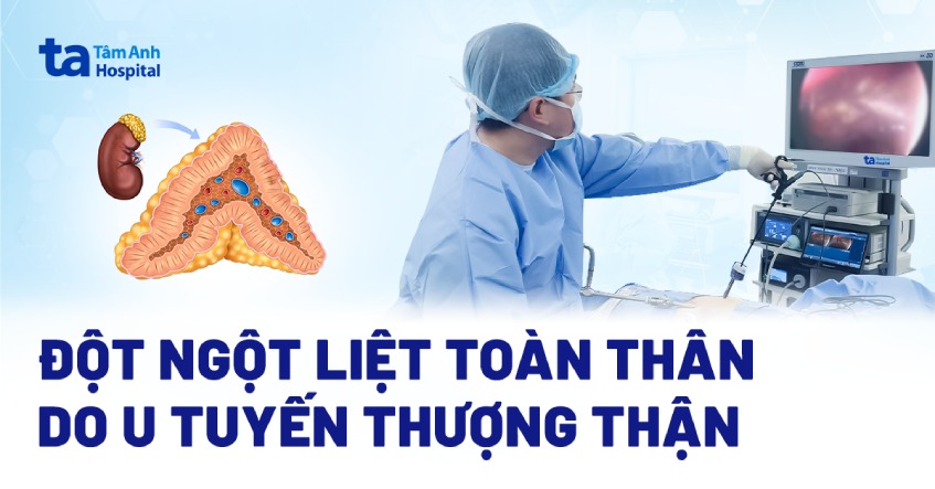 đột ngột liệt toàn thân do u tuyến thượng thận