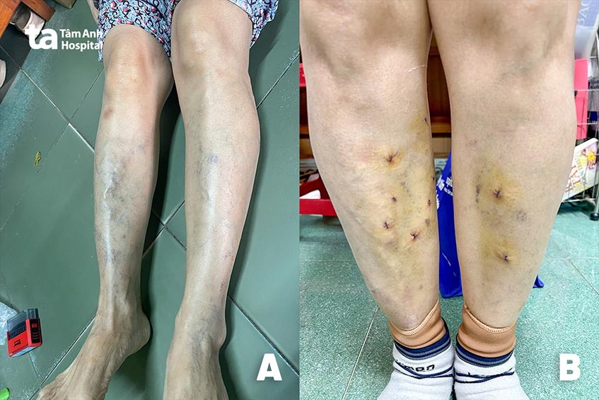Hai chân bệnh nhân chi chít những đường tĩnh mạch nổi gồ ghề (hình A) và sau khi bơm keo sinh học xử lý các tĩnh mạch bị suy giãn (hình B)
