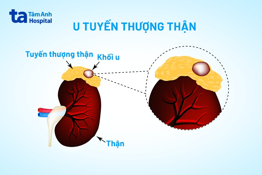 hình ảnh minh họa khối u tuyến thượng thận