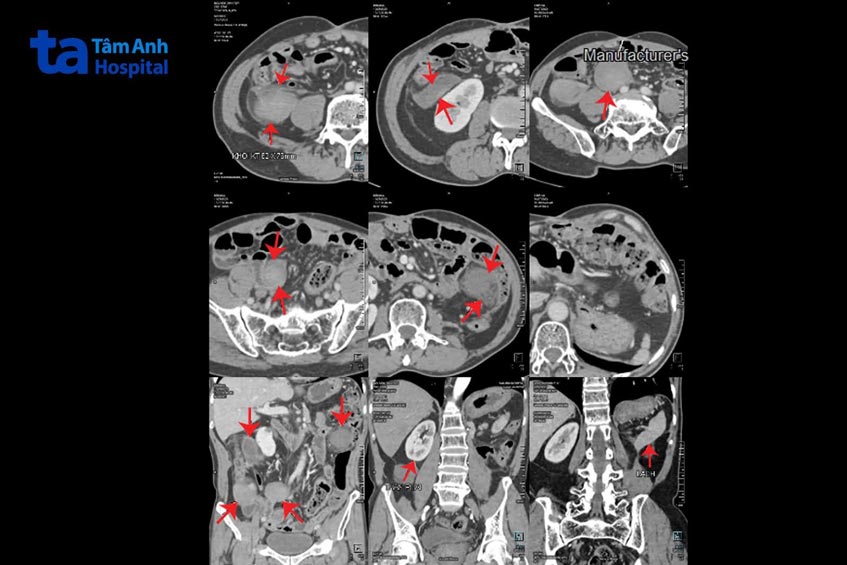 hình ảnh mri khối u mỡ