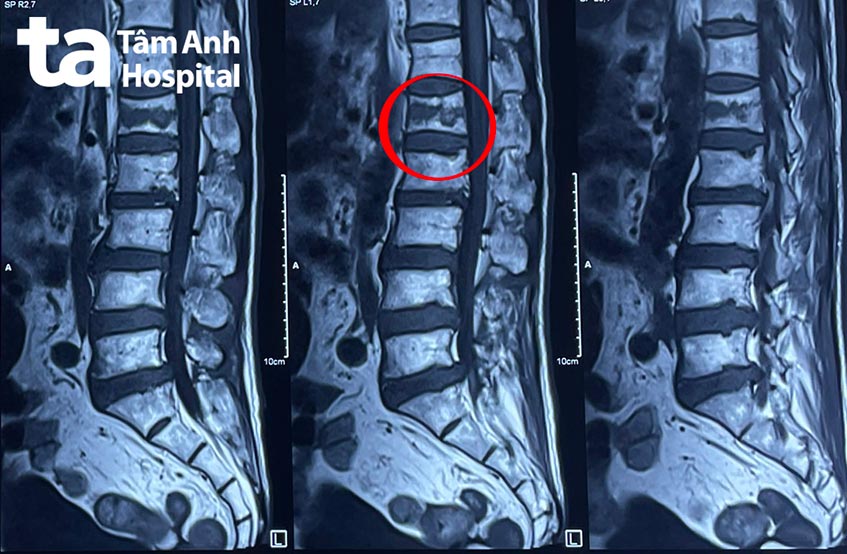 hình ảnh mri thoái hóa đốt sống