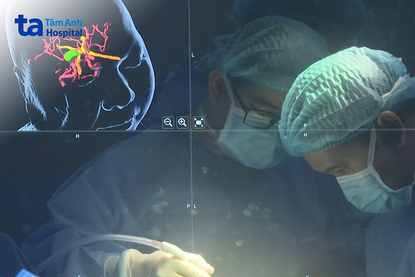 Khối u được dựng rõ ràng với hệ thống định vị thần kinh Neuro Navigation hiện đại