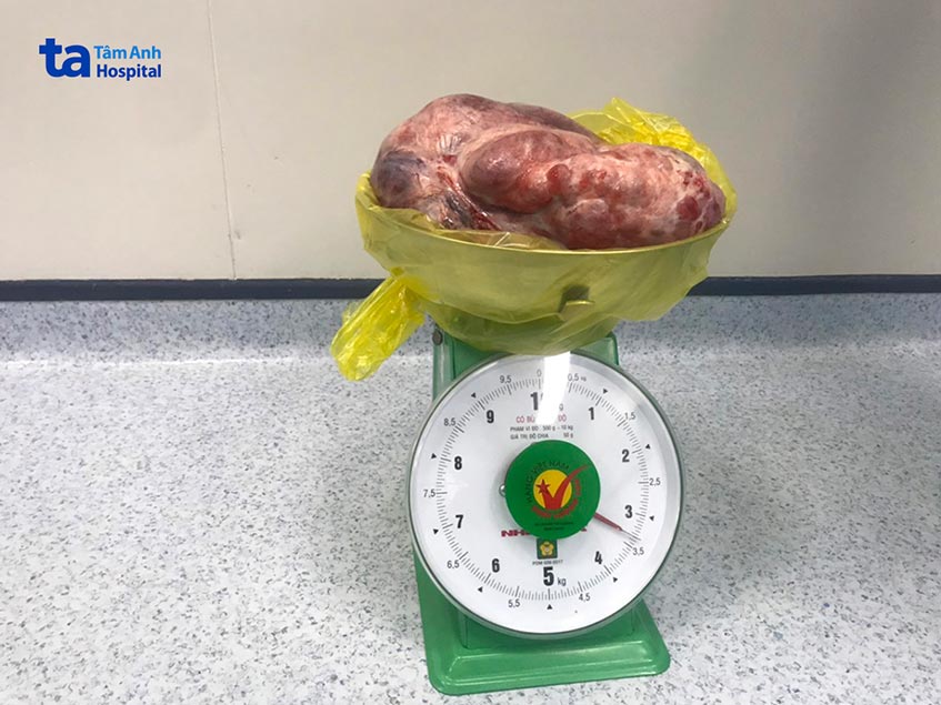 khối u được lấy ra khỏi thể