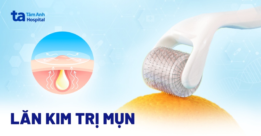 Lăn kim trị mụn đúng hay sai? Bị mụn có nên lựa chọn không?