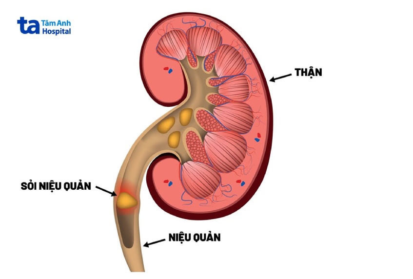 minh hỏa ảnh sỏi tắc niệu quản