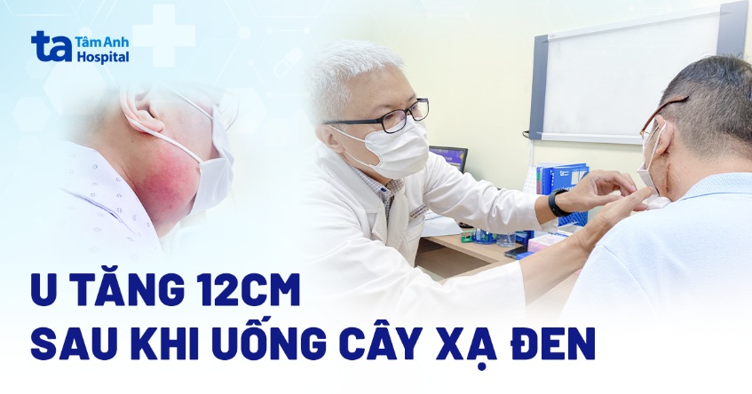 Mổ lấy u 12cm sau khi uống cây xạ đen không hiệu quả