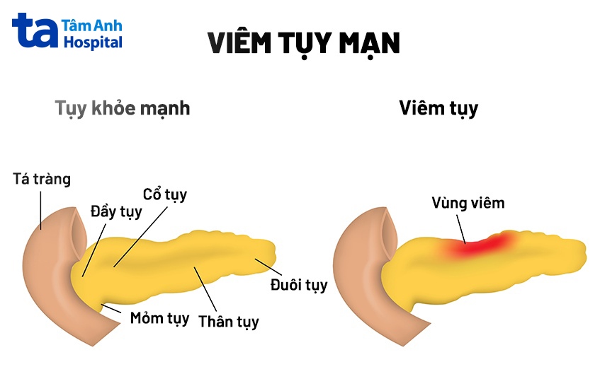 nội soi siêu âm đường tiêu hóa chẩn đoán bệnh gì