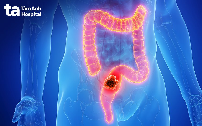 nội soi siêu âm trực tràng