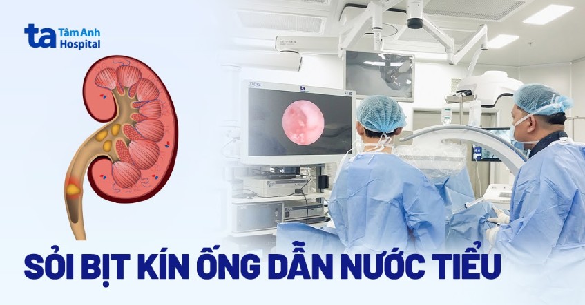 sỏi bịt kín ống dẫn nước tiểu