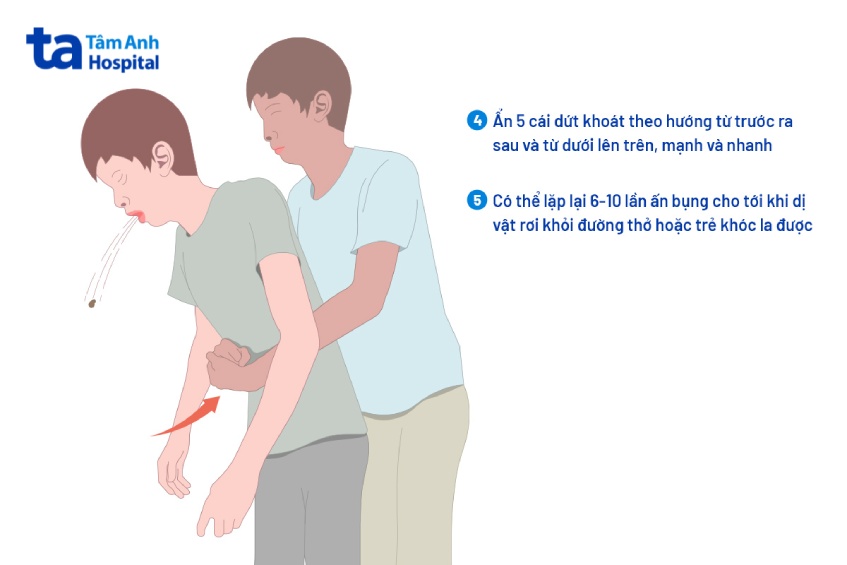tiến hành thủ thuật Heimlich