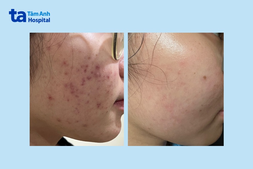 tình trạng da trước và sau điều trị