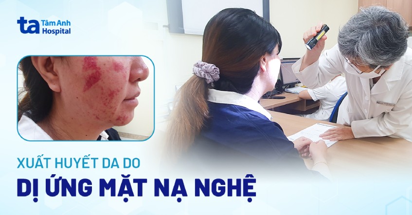 Da xuất huyết sau đắp mặt nạ nghệ