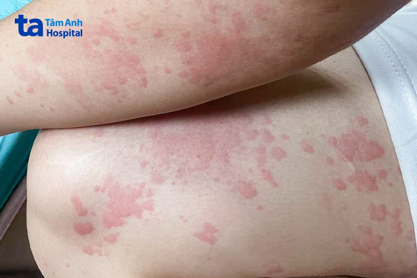 anh H. nổi mề đay phát ban