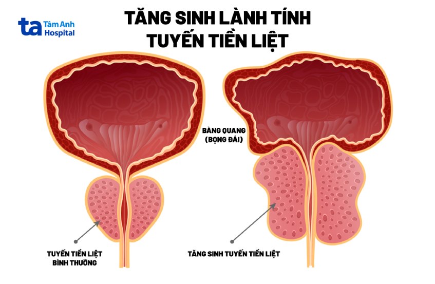 ảnh minh họa tăng sinh lành tính tuyến tiền liệt