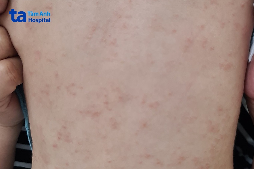 bé nhỏ bị viêm da cơ địa