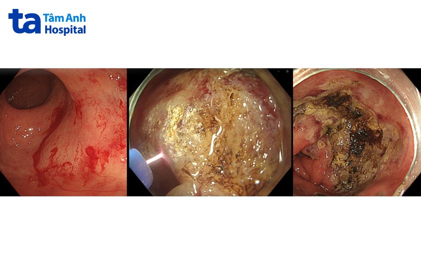 cầm máu ống tiêu hóa