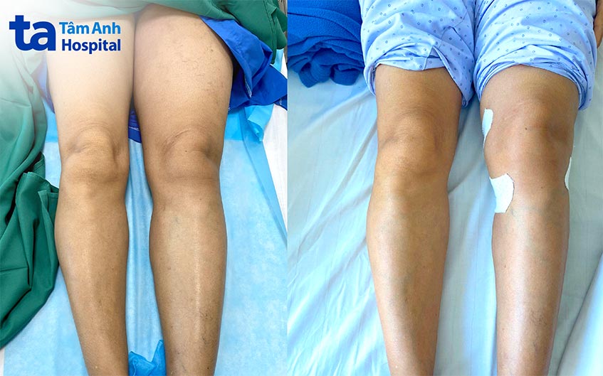 Chân trái bệnh nhân sưng phù (hình A) và sau khi can thiệp khơi thông đoạn tĩnh mạch tắc nghẽn (hình B)