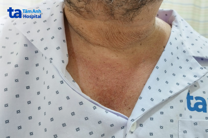 Da của ông B. bị khô và đỏ