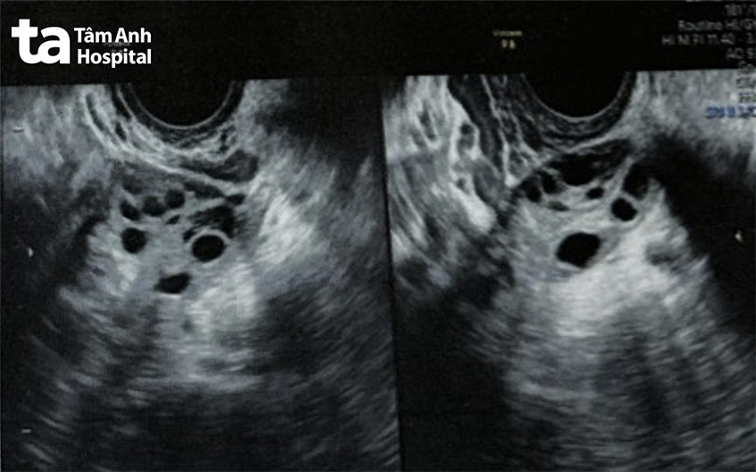Hình ảnh buồng trứng đa nang trên siêu âm