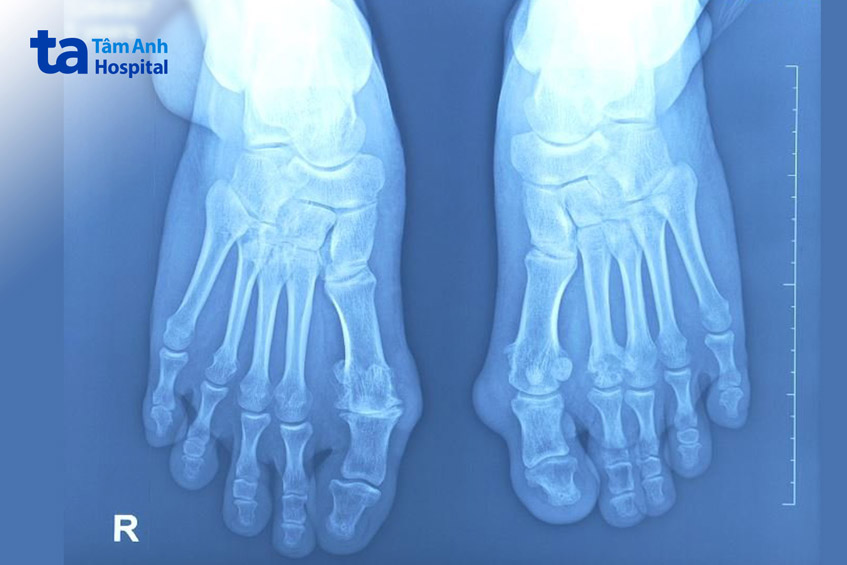 khối tophi biến dạng