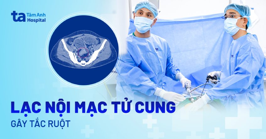 Lạc nội mạc tử cung làm tắc ruột