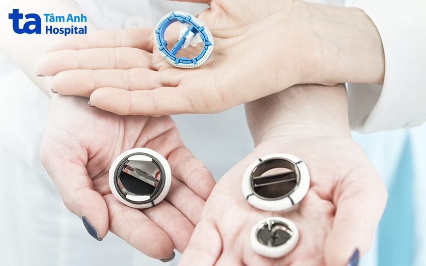 Thay van tim sống được bao nhiêu năm tùy thuộc vào loại van tim được chọn để thay thế