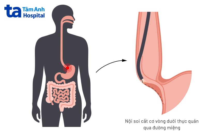 nội soi cắt cơ vòng dưới thực quản