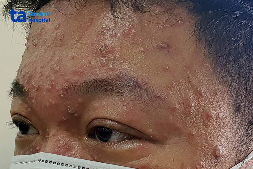 nốt mụn nước thủy đậu trên người bệnh