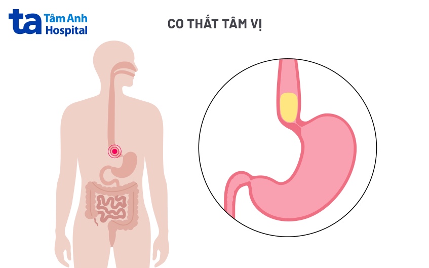 phẫu thuật cắt cơ nội soi qua miệng poem