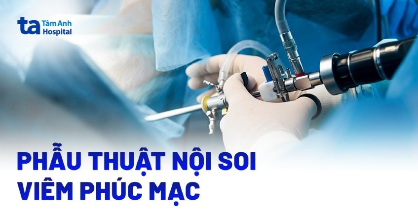Phẫu thuật nội soi viêm phúc mạc do viêm ruột thừa: Quy trình